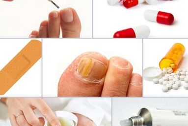 Wie man Nagelpilz behandelt