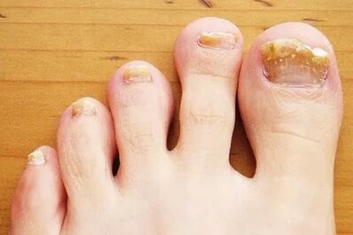 Nagelpilz