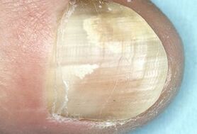 Schädigung der Nagelplatte durch eine Pilzinfektion